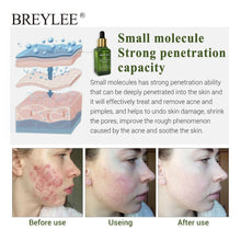 Load image into Gallery viewer, BREYLEE Acne Treatment Serum Face Facial Essence Anti Acne Scar Removal Cream Skin Care Whitening Repair Pimple Remover For Acne
